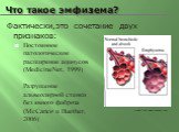 Постоянное патологическое расширение ацинусов (MedicineNet, 1999) Разрушение альвеолярной стенки без явного фиброза (McCance и Huether, 2006). Фактически,это сочетание двух признаков: Image from www.nucleusinc.com