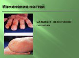 Изменение ногтей. Следствие хронической гипоксии