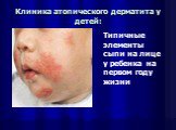 Клиника атопического дерматита у детей: Типичные элементы сыпи на лице у ребенка на первом году жизни