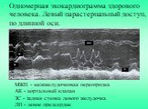 Одномерная эхокардиограмма здорового человека. Левый парастернальный доступ, по длинной оси. МЖП - межжелудочковая перегородка АК - аортальный клапан ЗС - задняя стенка левого желудочка ЛП - левое предсердие. АК МЖП ЗС ЛП
