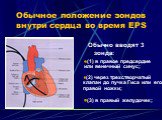 Обычное положение зондов внутри сердца во время EPS. Обычно вводят 3 зонда: (1) в правое предсердие или венечный синус; (2) через трехстворчатый клапан до пучка Гиса или его правой ножки; (3) в правый желудочек;