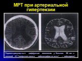 МРТ при артериальной гипертензии