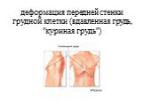 деформация передней стенки грудной клетки (вдавленная грудь, "куриная грудь")