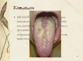 Кандидоз. МОЛОЧНИЦА, одна из форм кандидоза слизистой оболочки полости рта, главным образом у грудных детей (покраснение, образование беловатых налетов, язвочек).