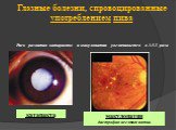 Глазные болезни, спровоцированные употреблением пива Риск развития катаракты и макулопатии увеличивается в 1.5-3 раза. макулопатия дистрофия желтого пятна. катаракта