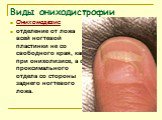 Онихомадезис отделение от ложа всей ногтевой пластинки не со свободного края, как при онихолизисе, а с проксимального отдела со стороны заднего ногтевого ложа.