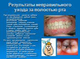 Результаты неправильного ухода за полостью рта. При неправильном уходе за зубами на них образуется зубной налет, который является источником  инфекции (воспаление твердых и мягких тканей зуба, околозубных тканей). Налет в основном  откладывается в  области перехода коронки зуба в корень (шейка зуба)