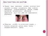 Диагностика по ногтям. Длинные линии (продольные желобки) на ногтях могут указывать на плохую всасываемость пищи в системе пищеварения, несбалансированное питание, наличие хронических воспалительных заболеваний (придаточных пазух носа, зубов или начинающегося ревматизма). Поперечные желобки на ногтя