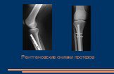 Рентгеновские снимки протезов