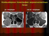 Компьютерная томография верхнечелюстных пазух. до операции после операции