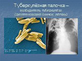 Туберкулёзная палочка – возбудитель туберкулёза (рентгеновский снимок лёгких)