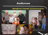 Альбинизм. Врождённое отсутствие пигмента меланина