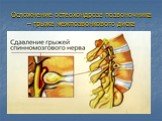Осложнение остеохондроза позвоночника – грыжа межпозвонкового диска