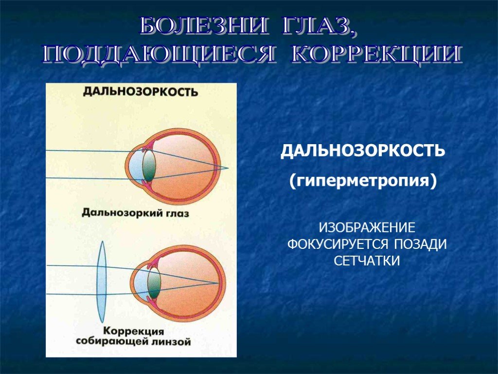 Заболевания глаз биология 8 класс. Дальнозоркость глаз. При гиперметропии изображение фокусируется. Дальнозоркость изображение. Коррекция гиперметропии.