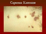 Саркома Капоши