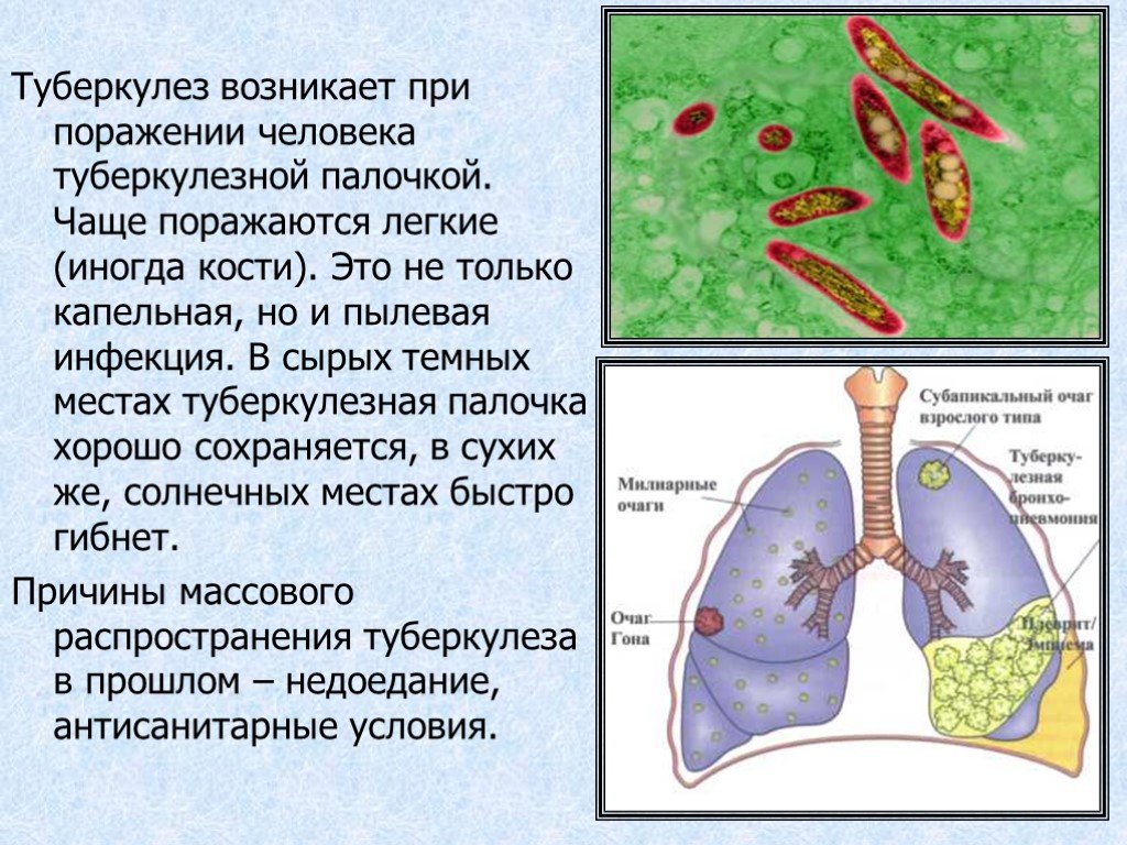 Появление туберкулеза. Туберкулез легких презентация. Презентация на тему туберкулез легких.