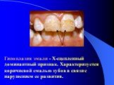 Гипоплазия эмали - Х-сцепленный доминантный признак. Характеризуется коричневой емалью зубов в связи с нарушением ее развития.