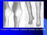 Гемофилия. Гемартрозы коленных суставов (а) и стоп (б)