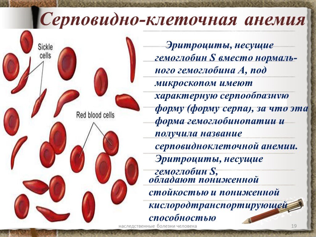 Эритроциты при серповидно клеточной анемии. Серповидноклеточная анемия под микроскопом. Серповидноклеточная анемия эритроциты. Серповидно-клеточная анемия (s-гемоглобинопатия). Гемоглобин серповидноклеточная анемия биохимия.