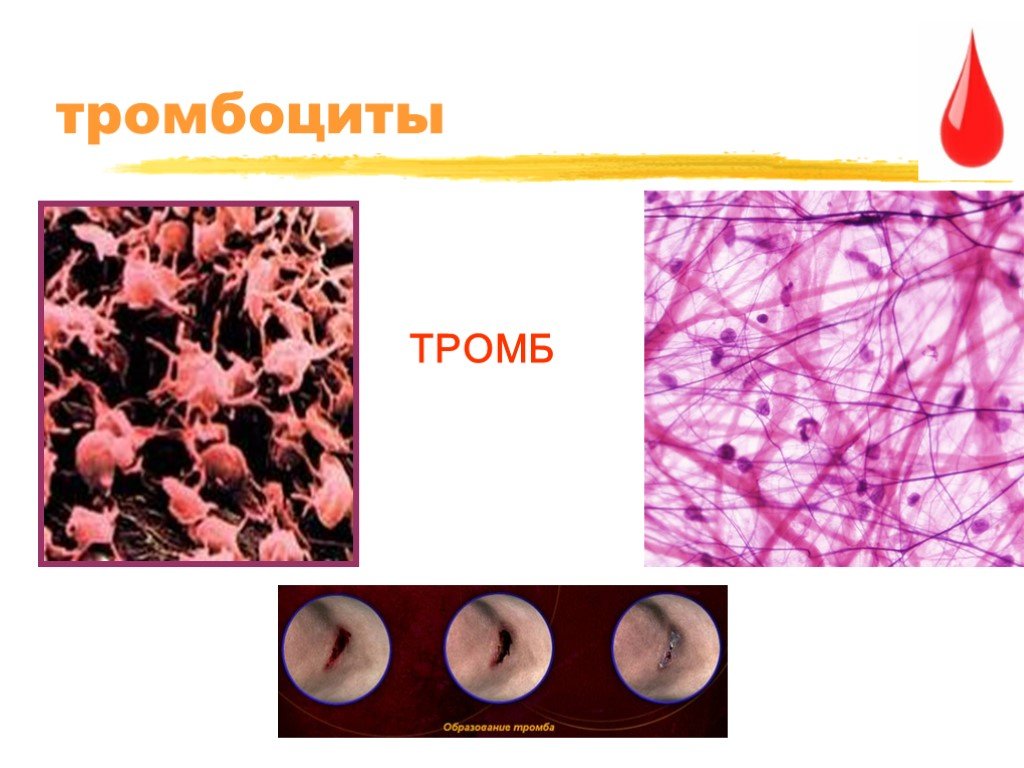 Тромбоциты и тромбы. Тромбоциты образование тромба. Тромбоциты тромбы и тромбоз. Тромбоциты картинки.
