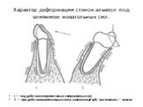 Характер деформации стенок альвеол под влиянием жевательных сил. I — под действием горизонтально направленных сил; 2 — при действии вертикальных сил на наклоненный зуб; + растяжение, — сжатие.