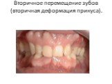 Вторичное перемещение зубов (вторичная деформация прикуса).