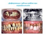 Деформации зубных рядов при пародонтите