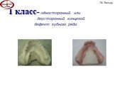 I класс- односторонний или двусторонний концевой дефект зубного ряда. По Вильду