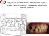 Нарушение окклюзионной поверхности зубных рядов, препятствующее свободным движениям нижней челюсти.