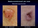 Базальноклеточный рак кожи. Внешний вид опухоли: Начало заболевания Изъязвление