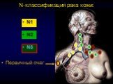 N-классификация рака кожи: N1 N2 N3 Первичный очаг