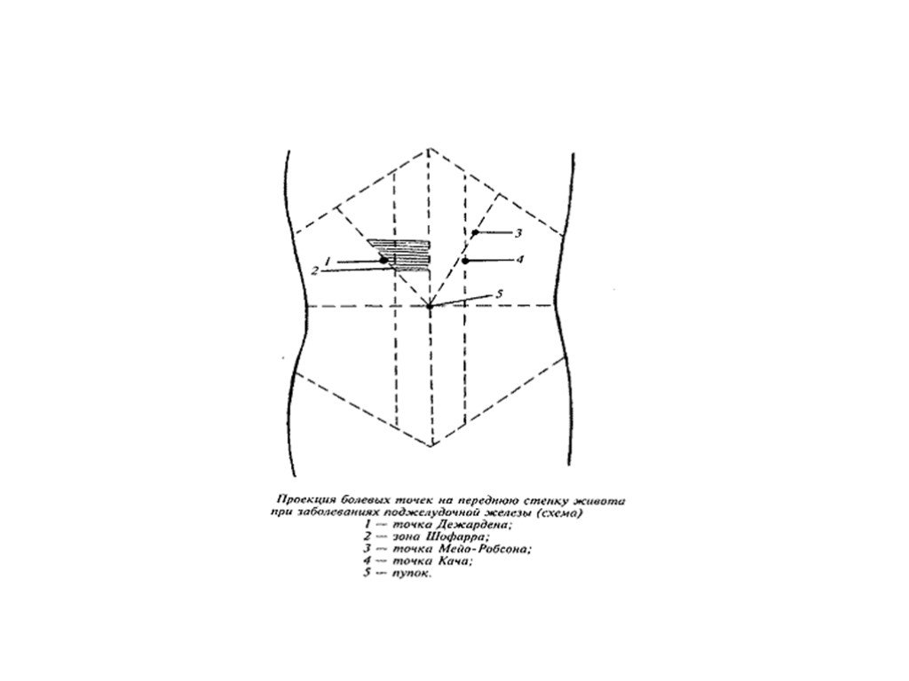 Проекция передней брюшной стенки. Точка Дежардена и Мейо-Робсона. Точка кача Мейо-Робсона и Дежардена. Точка Дежардена и зона Шоффара точка Мейо-Робсона. Точка Мейо Робсона 1.