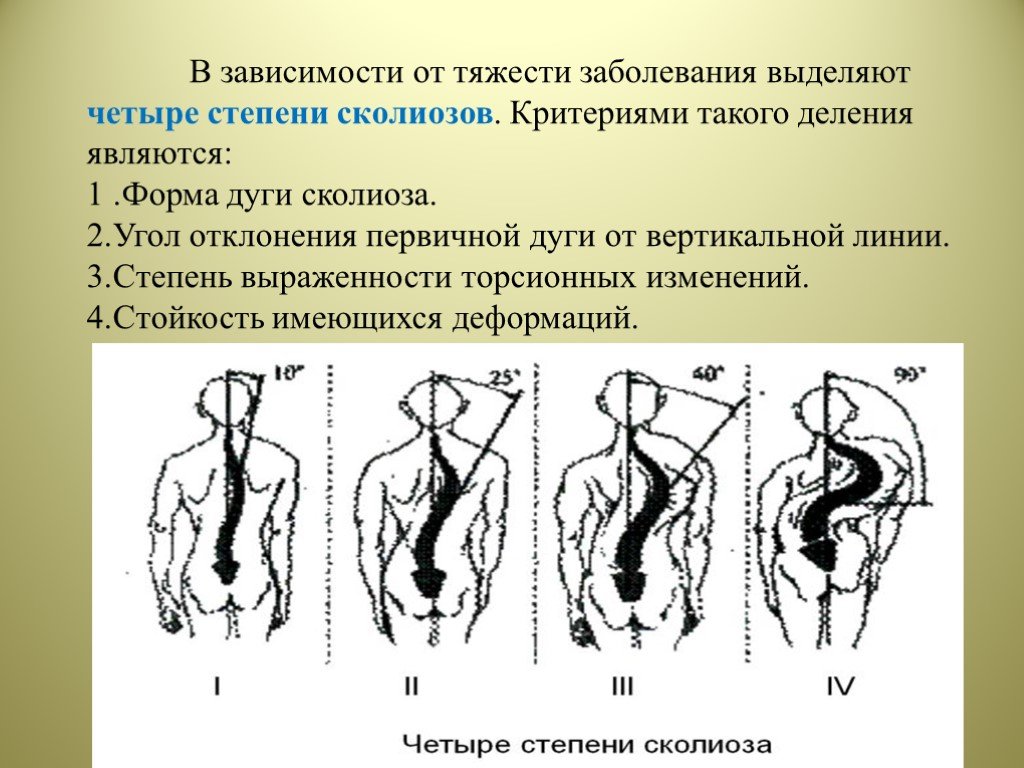 Степени искривления позвоночника. Сколиоз степени тяжести. Сколиоз критерии. Сколиоз степень выраженности. Классификация сколиоза в зависимости от степени тяжести.