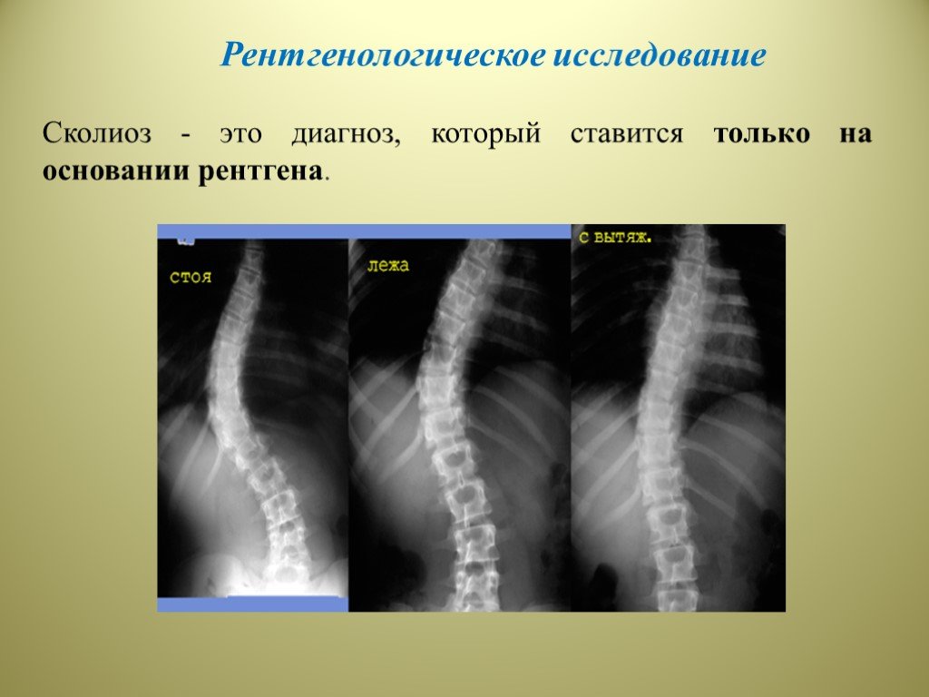 Презентация на тему сколиоз