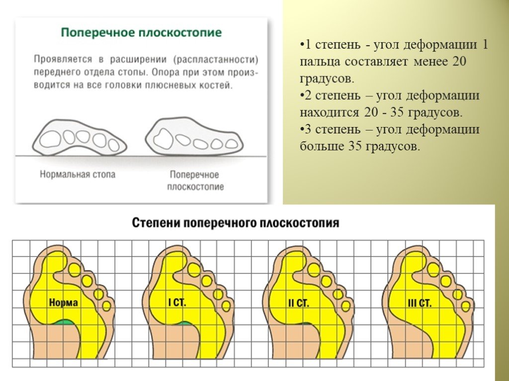 Степени плоскостопия таблица с картинками