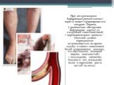 При атеросклерозе бифуркации(разветвление) аорты может сформироваться синдром Лериша (хроническая обструкция бифуркации аорты) со следующей симптоматикой: • перемежающаяся хромота — (больной должен периодически останавливаться во время ходьбы в связи с появлением болей в икроножных мышцах, что обусл