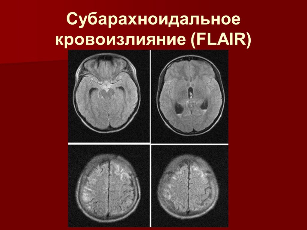 Степени кровоизлияния. Субарахноидальное кровоизлияние мрт. Субарахноидальные кровоизлияния кт и мрт. Субарахноидальное кровоизлияние мрт картина. Травматическое субарахноидальное кровоизлияние на мрт.