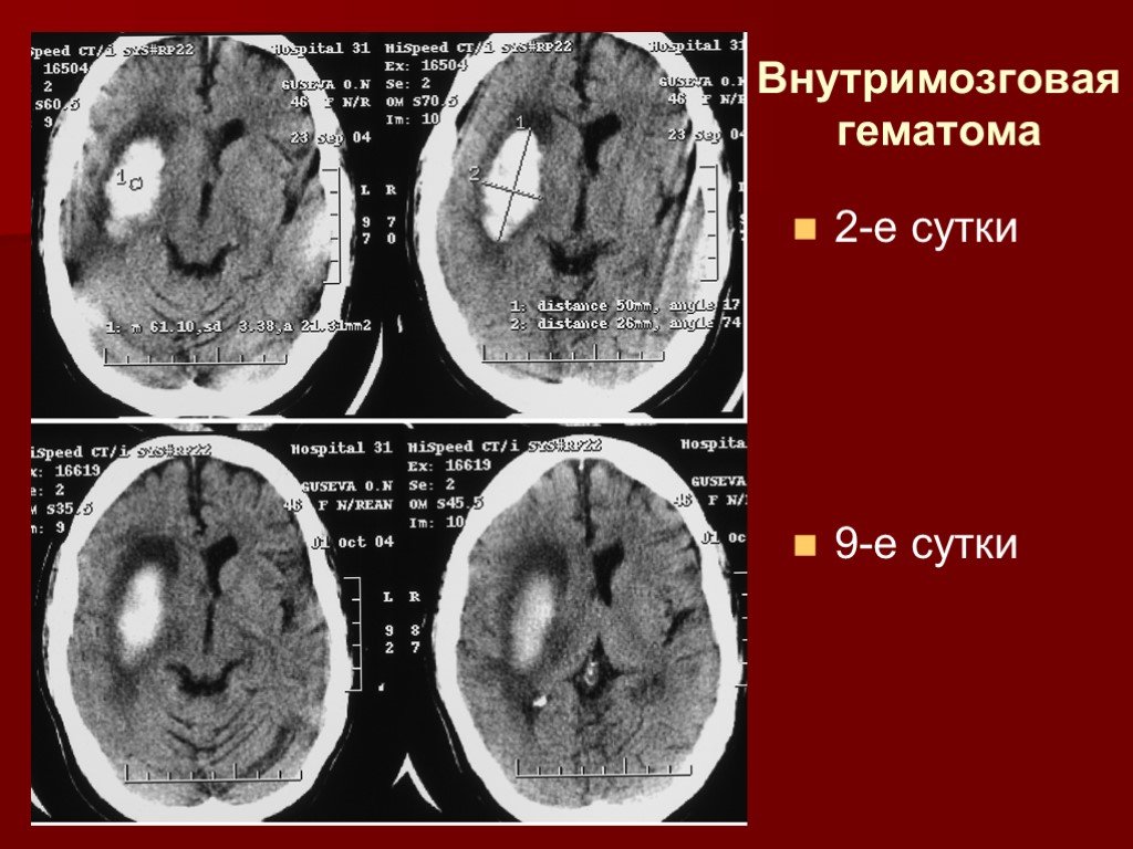 Гематома головного мозга рассасывается. Травматическая внутримозговая гематома кт. Геморрагический инсульт мрт гематома. Внутримозговая гематома головного мозга мрт. Внутримозговая гематома стадии развития на кт.