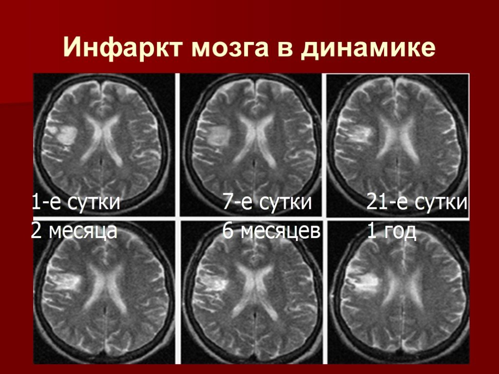 Инфаркт головного мозга фото