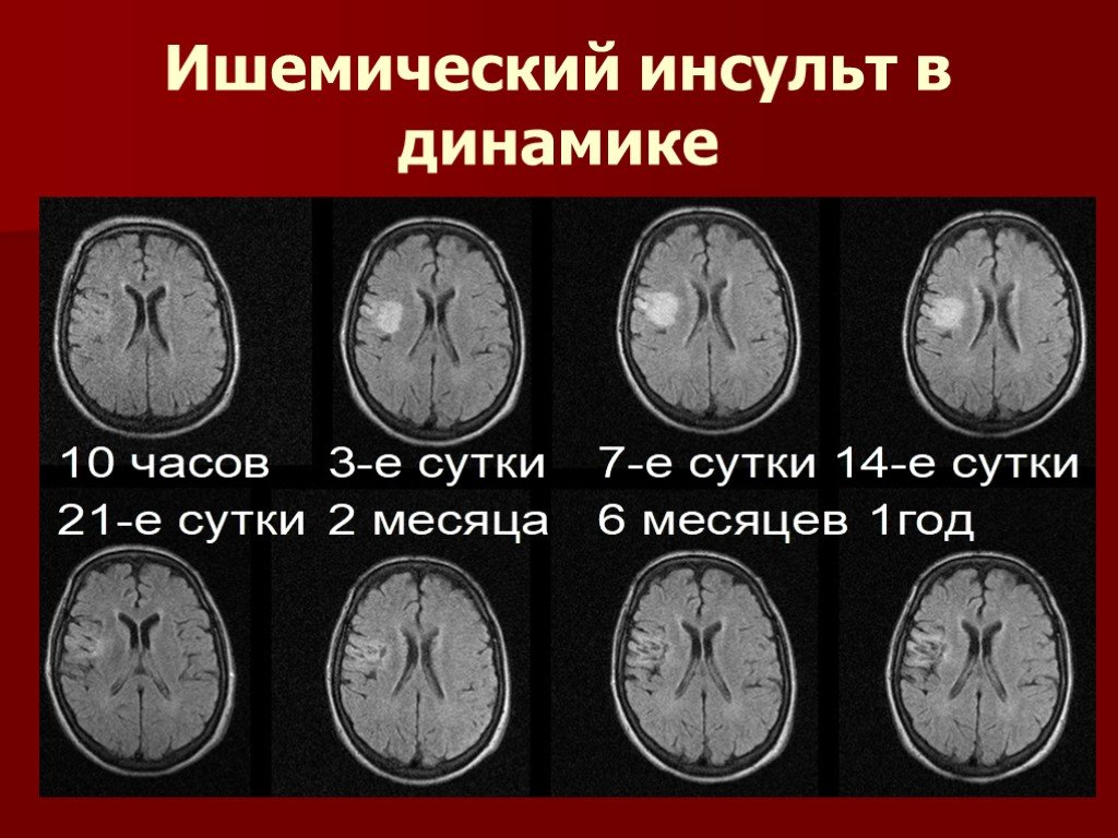 Инсульт на мрт головного мозга картинки