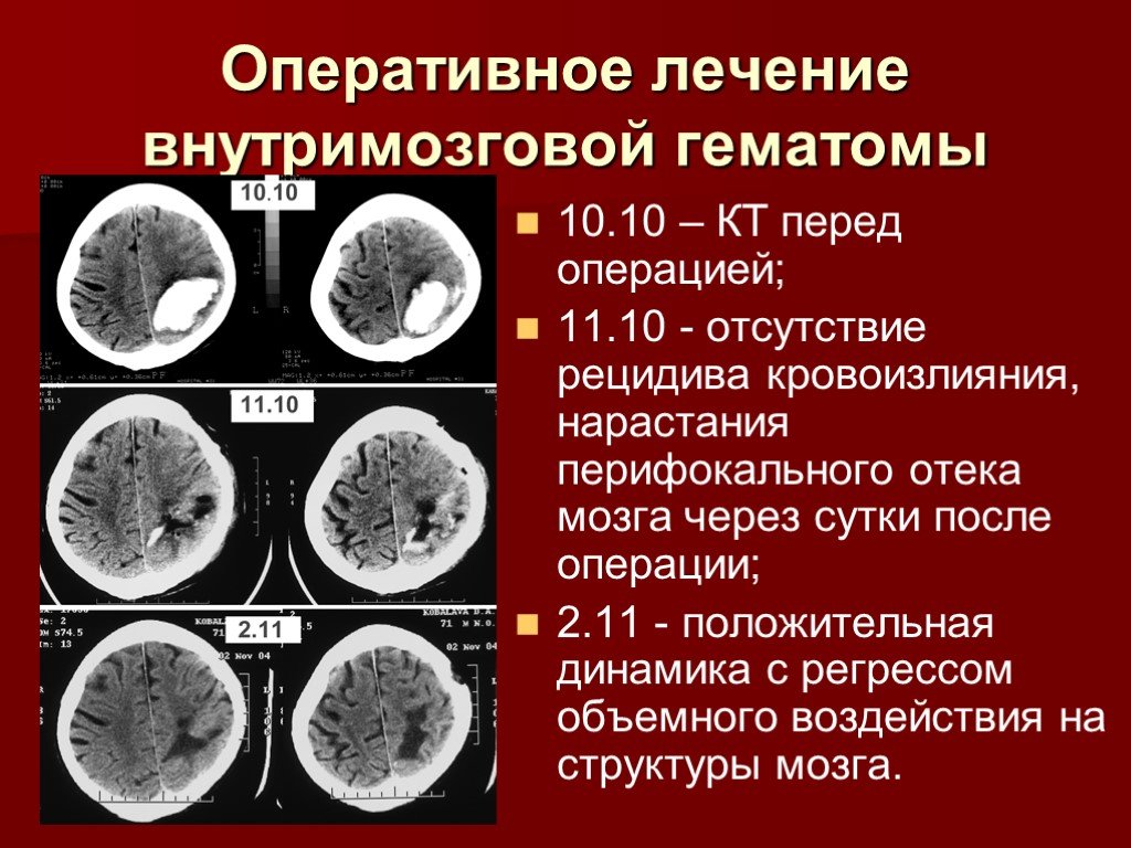 После оперативного. Внутримозговая гематома классификация кт. Внутримозговая гематома кт описание. Перифокальный отек головного мозга на кт. Кт мозга внутримозговая гематома.