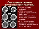 Оперативное лечение внутримозговой гематомы. 10.10 – КТ перед операцией; 11.10 - отсутствие рецидива кровоизлияния, нарастания перифокального отека мозга через сутки после операции; 2.11 - положительная динамика с регрессом объемного воздействия на структуры мозга.