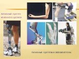активный протез коленного сустава. Активные протезы и экзоскелетоны