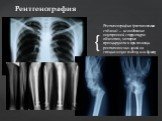 Рентгенография (рентгеновская съёмка) — исследование внутренней структуры объектов, которые проецируются при помощи рентгеновских лучей на специальную плёнку или бумагу. Рентгенография