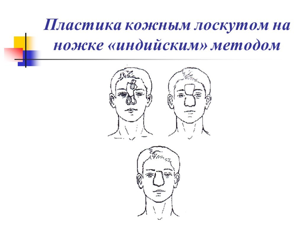 Кожная пластика кожным лоскутом. Пластика лоскутом на ножке. Пластика кожным лоскутом на ножке. Пластика лоскутом на питающей ножке. Пластика лоскутом на питающей ножке методики.