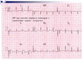 ЭКГ при нижнем инфаркте миокарда с поражением правого желудочка.