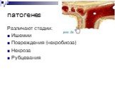 Различают стадии: Ишемии Повреждения (некробиоза) Некроза Рубцевания
