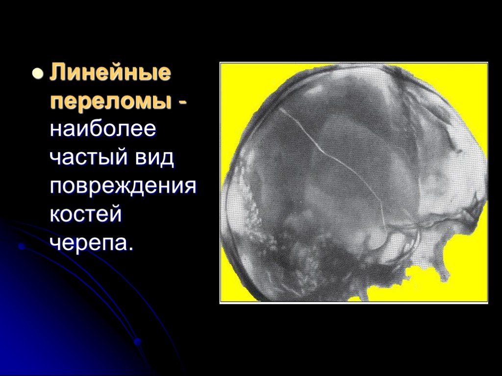 Перелом теменной кости у грудного. Паутинообразный перелом костей свода черепа. Перелом теменной кости черепа рентген. Переломы затылочной кости классификация. Импрессионный перелом свода черепа.