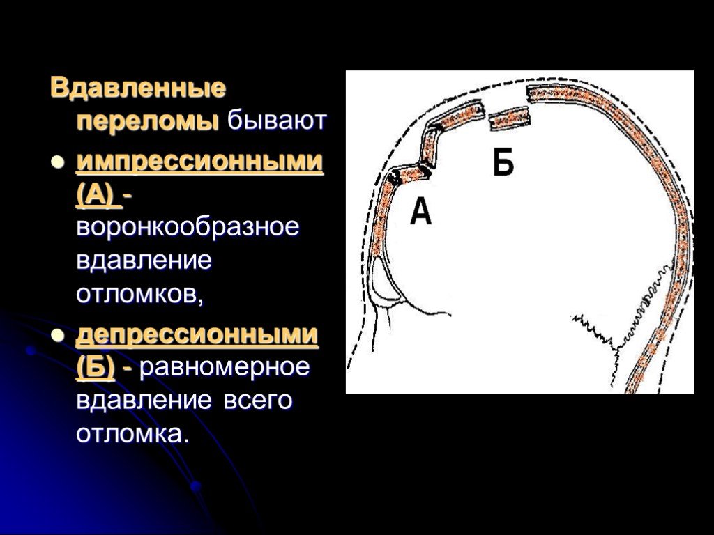 Импрессионный перелом. Импрессионный перелом костей черепа. Импрессионный вдавленный перелом. Импрессионные вдавленные переломы черепа.