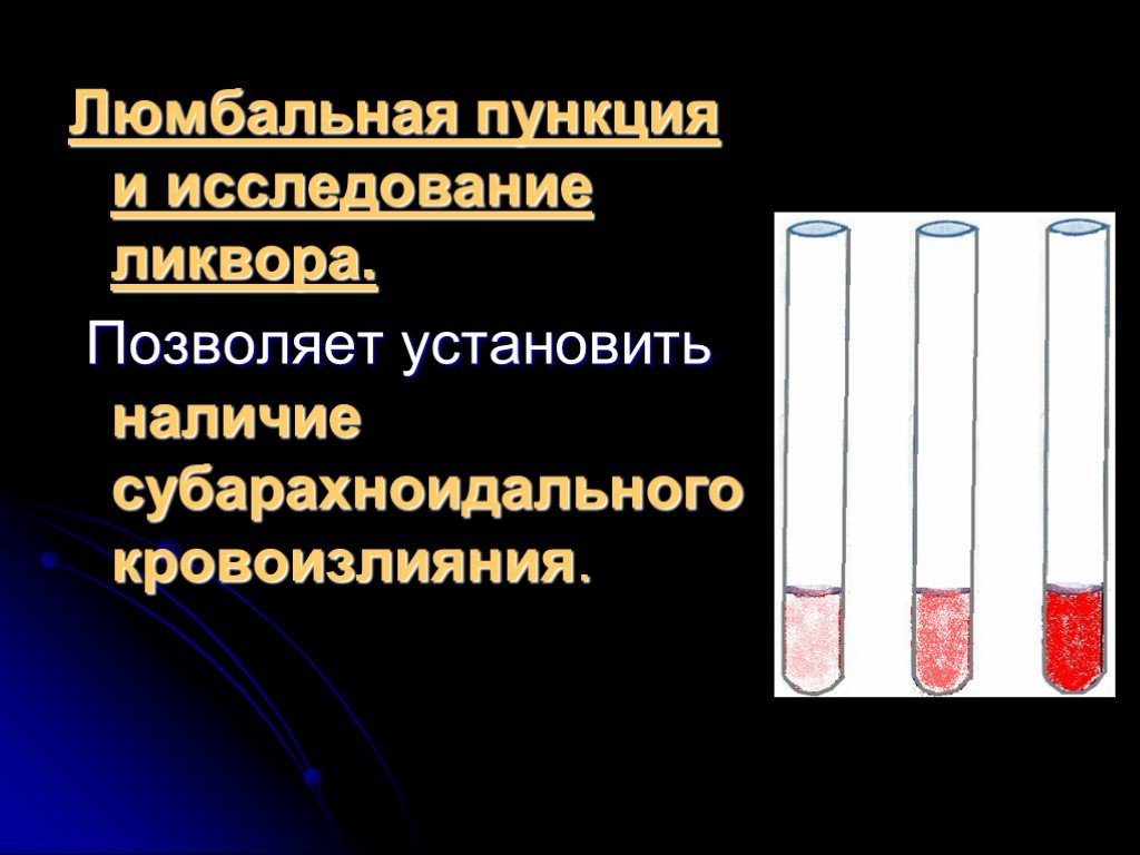 Установите наличие. Люмбальная пункция и исследование ликвора. Ликвор при субарахноидальном кровоизлиянии. Субарахноидальное кровоизлияние люмбальная пункция. Люмбальная пункция при субарахноидальном кровоизлиянии.